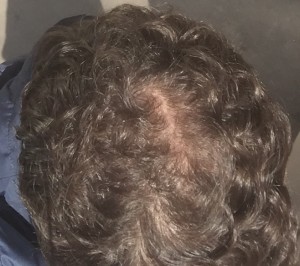 Follicle challenge: James' crown after eight years' ongoing treatment to reverse and ward off hair loss